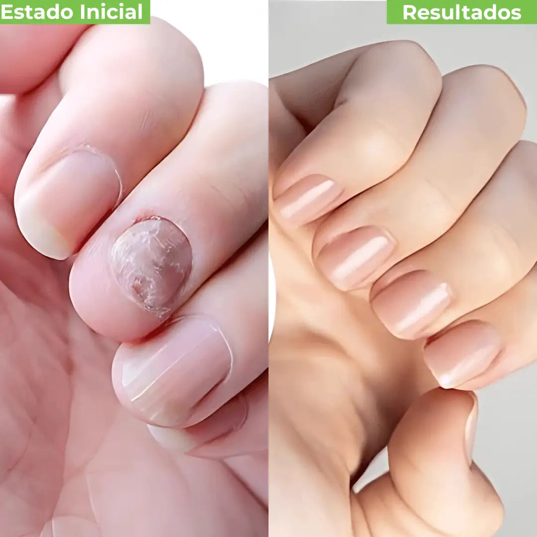 Auré Pro™ Parches Antihongos de Renovación Profunda.