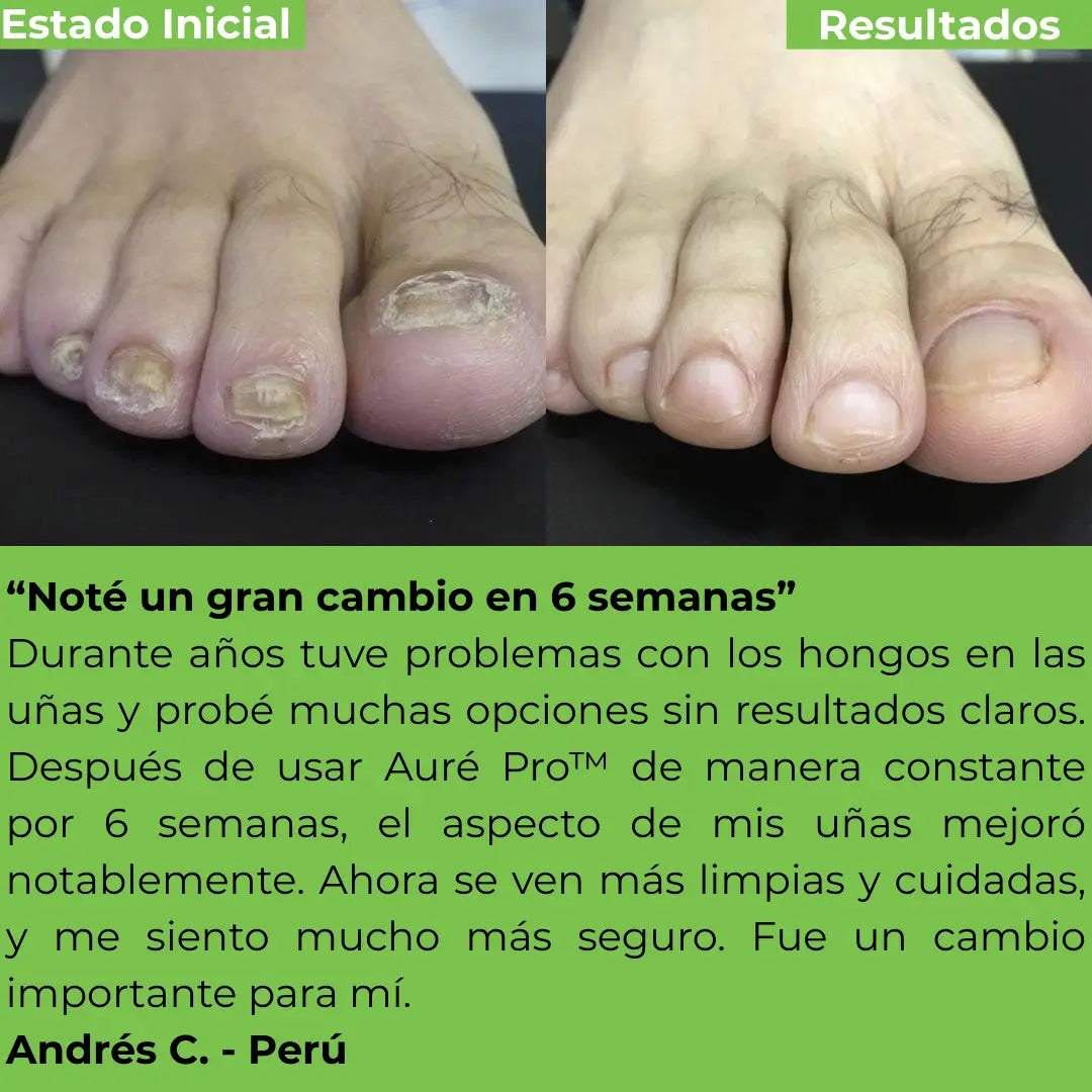 Auré Pro™  Parches Antihongos de Renovación Profunda.