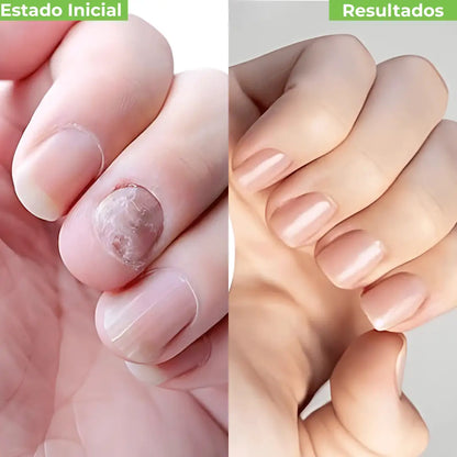 Auré Pro™  Parches Antihongos de Renovación Profunda.